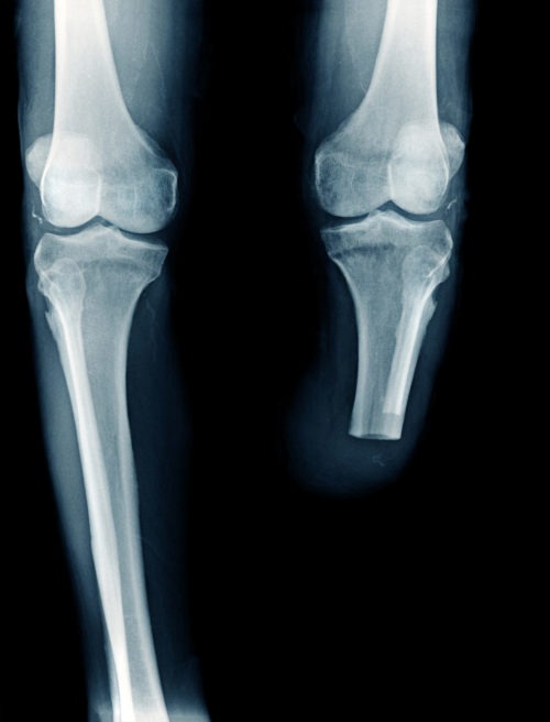 Intravascular shunts improve early limb salvage after extremity vascular injury, study finds