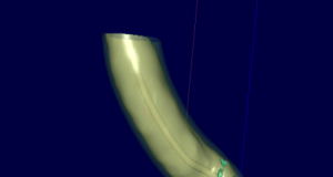 Unveiling an AI-driven risk stratification tool to attain better stroke prediction