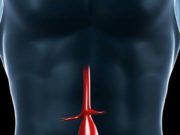 Shape Memory Medical completes enrollment in the AAA-SHAPE early feasibility study