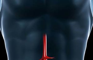 Shape Memory Medical completes enrollment in the AAA-SHAPE early feasibility study