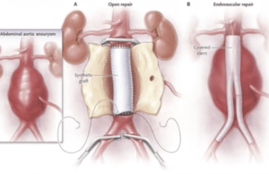 Family history risk of AAA ‘increases incrementally’ based on degree of relation