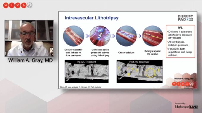 Intravascular lithotripsy ‘superior’ to PTA in acute procedural success out to 30 days