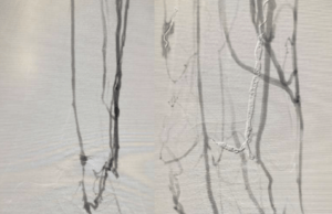 Foot vein arterialization study shows 77.8% limb salvage rate
