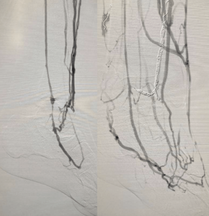 Foot vein arterialization study shows 77.8% limb salvage rate
