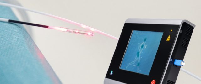 Study: ELVeS Radial varicose vein laser therapy shows ‘excellent’ long-term results