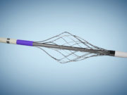 Surmodics builds thrombectomy portfolio with acquisition of Vetex Medical