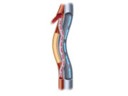 PAD: Endologix acquires PQ Bypass