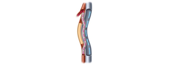 PAD: Endologix acquires PQ Bypass