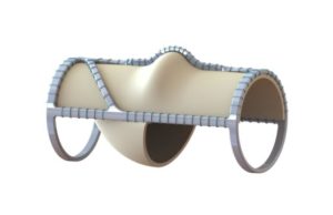 Envveno Medical reports successful completion of first VenoValve surgery in US pivotal trial