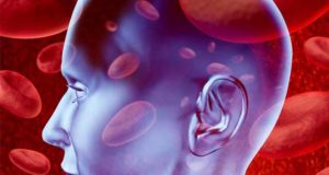 SVS has patient resources and guidelines on strokes