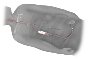 TCAR: First patient enrolled in ROADSTER 3 post-approval study