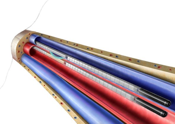 Enrollment starts in postmarket studies of WavelinQ endoAVF system