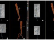 Lead vascular surgeon on first use of Fiber Optic RealShape in US hails advance