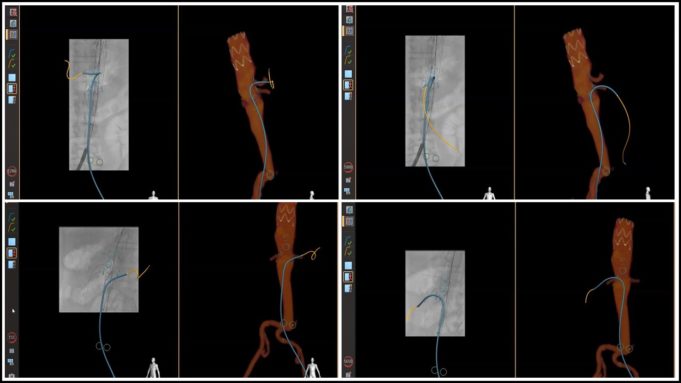 Lead vascular surgeon on first use of Fiber Optic RealShape in US hails advance