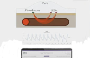 Wearable device for AV fistula remote monitoring shows promise—but faces commercial challenges