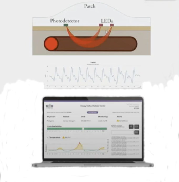 Wearable device for AV fistula remote monitoring shows promise—but faces commercial challenges