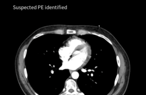 AI triage solution for PE and aortic dissection receives FDA clearance