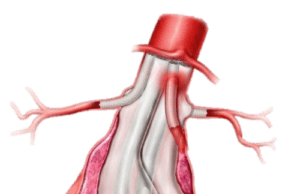 Endologix receives FDA Breakthrough Device designation for ChEVAS system