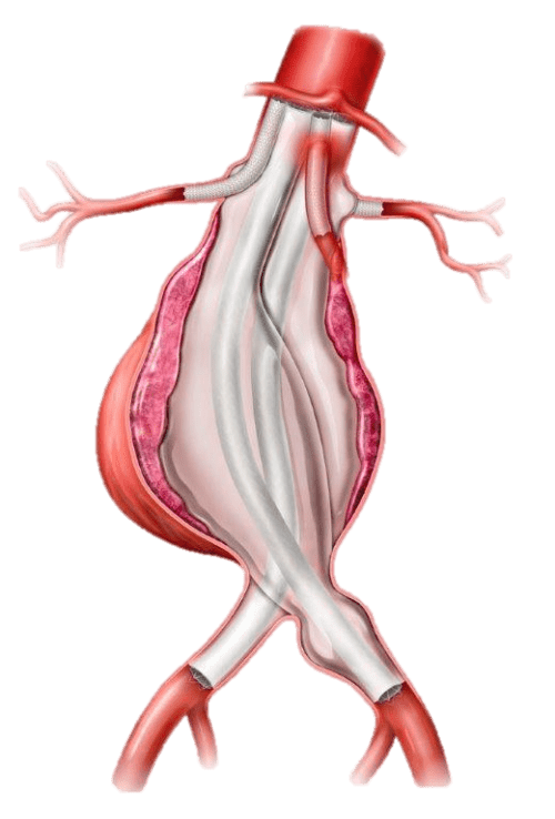 Endologix receives FDA Breakthrough Device designation for ChEVAS system