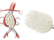 First patient enrolled in AAA-SHAPE Netherlands study