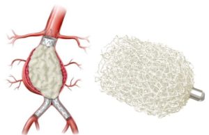 First patient enrolled in AAA-SHAPE Netherlands study