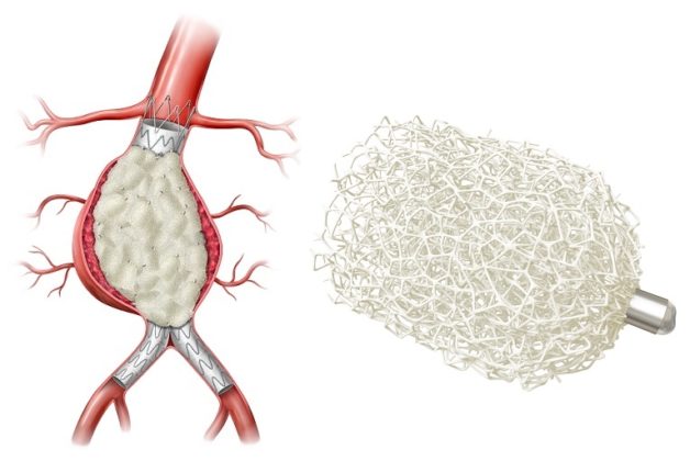 First patient enrolled in AAA-SHAPE Netherlands study