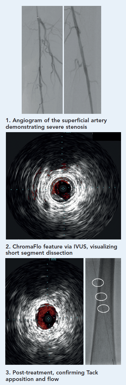 The latest innovation in intravascular ultrasound: Reconnaissance PV ...