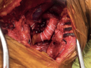 Fusion Bioline vascular graft demonstrates improved patency rates and reduced time to hemostasis