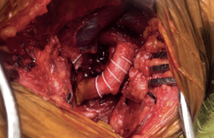 Fusion Bioline vascular graft demonstrates improved patency rates and reduced time to hemostasis