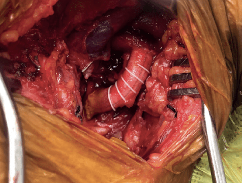 Fusion Bioline vascular graft demonstrates improved patency rates and reduced time to hemostasis