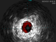 The latest innovation in intravascular ultrasound: Reconnaissance PV .018 OTW digital IVUS catheter