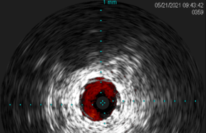 The latest innovation in intravascular ultrasound: Reconnaissance PV .018 OTW digital IVUS catheter