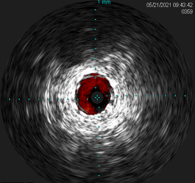 The latest innovation in intravascular ultrasound: Reconnaissance PV .018 OTW digital IVUS catheter