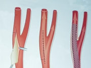 Five-year ACST-2 results: Carotid artery surgery and stenting have similar long-term effects on stroke