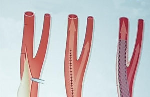 Five-year ACST-2 results: Carotid artery surgery and stenting have similar long-term effects on stroke