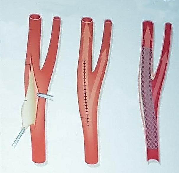 Five-year ACST-2 results: Carotid artery surgery and stenting have similar long-term effects on stroke