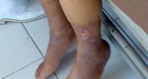 Only a few seats remain for CPVI hands-on skills course