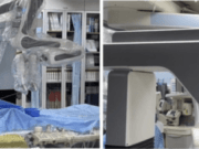 Clinical evaluation of robotic-assisted peripheral artery intervention in human completed