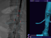First patient treated in global strategic collaboration involving Cydar Maps technology
