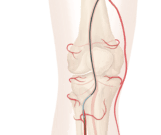 Cook Medical receives FDA breakthrough designation for new drug-eluting stent