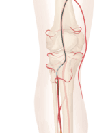 Cook Medical receives FDA breakthrough designation for new drug-eluting stent