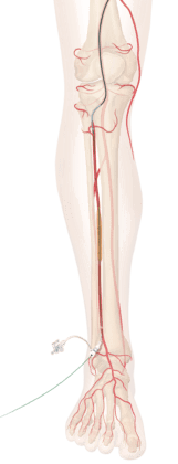 Cook Medical receives FDA breakthrough designation for new drug-eluting stent