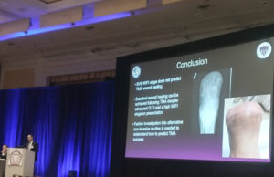 SCVS 2022: WIfI score does not predict successful healing after transmetatarsal amputation, study finds