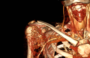 Rare case series shows 100% limb salvage in pediatric bone tumor resections with vascular involvement