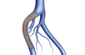 Venovo venous stent returns to US market after 2021 recall
