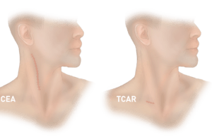 FDA approves expanded indications for TCAR’s Enroute stent