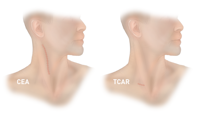 Silk Road to evaluate TCAR in standard surgical risk patients with ROADSTER 3 study