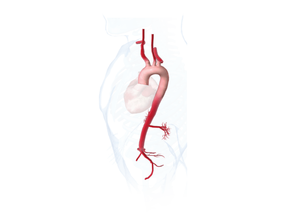 Hybrid aortic arch: ‘We believe there is still a role for a versatile multiple-branched arch option’