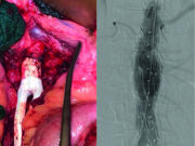 Aortobifemoral grafting in the endovascular era: An exploration of the open procedure and its merits among ‘good-risk’ patients today