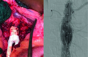 Aortobifemoral grafting in the endovascular era: An exploration of the open procedure and its merits among ‘good-risk’ patients today